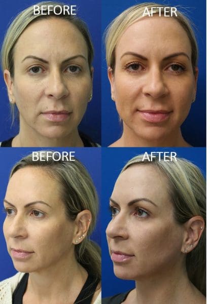 Facial Implants Before and After Pictures West Palm Beach, FL