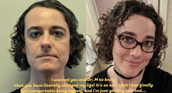 Smile Lift Before and After Pictures West Palm Beach, FL