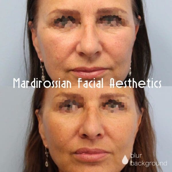 Cheek Implants Before and After Pictures West Palm Beach, FL