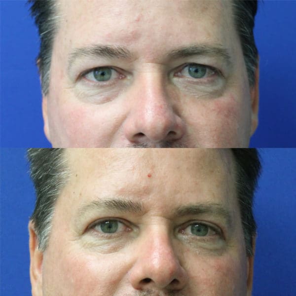 Blepharoplasty Before and After Pictures West Palm Beach, FL