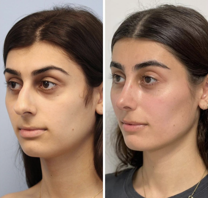 Feminization Rhinoplasty Before and After Pictures McLean, VA