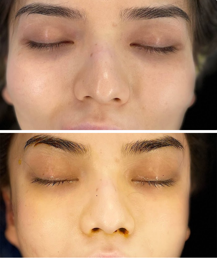 Cheekbone Reduction Before and After Pictures McLean, VA