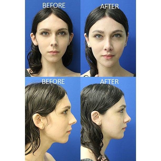 Mandible Contouring Before and After Pictures McLean, VA