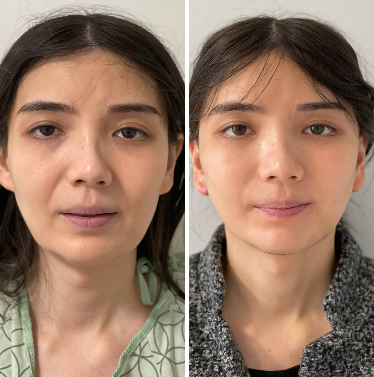 Facelift2 Midface Lift Before and After Pictures McLean, VA