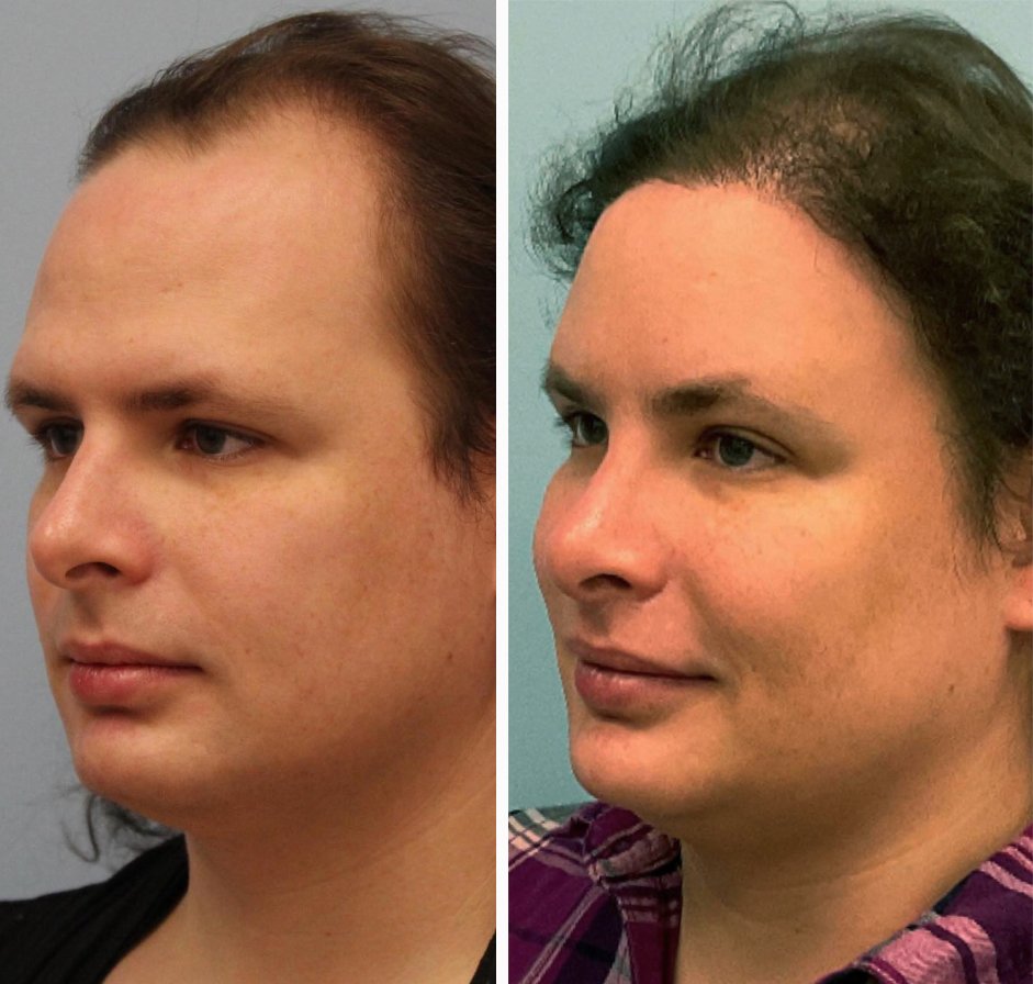Hair Restoration Treatments in McLean, VA