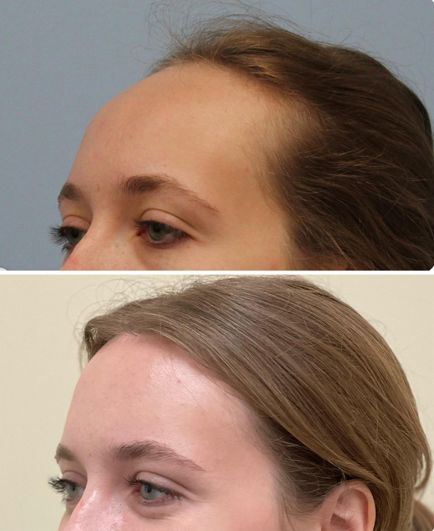 Forehead Contouring Before and After Pictures McLean, VA
