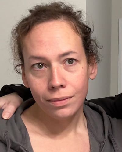 Mardirossian Facial Aesthetics Before and After Pictures